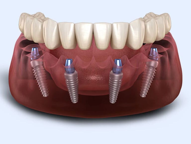 Innovative All-On-4 dental implants — 123 iSmile Modesto CA