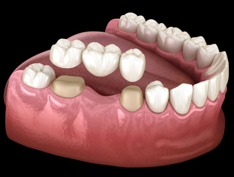Dental Bridge — 123 iSmile Modesto CA