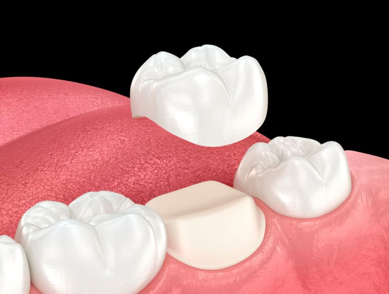 Dental Crowns — 123 iSmile Modesto CA