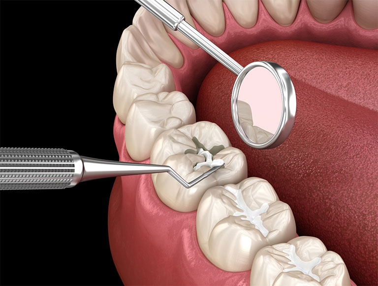 Dental Sealants — 123 iSmile Modesto CA