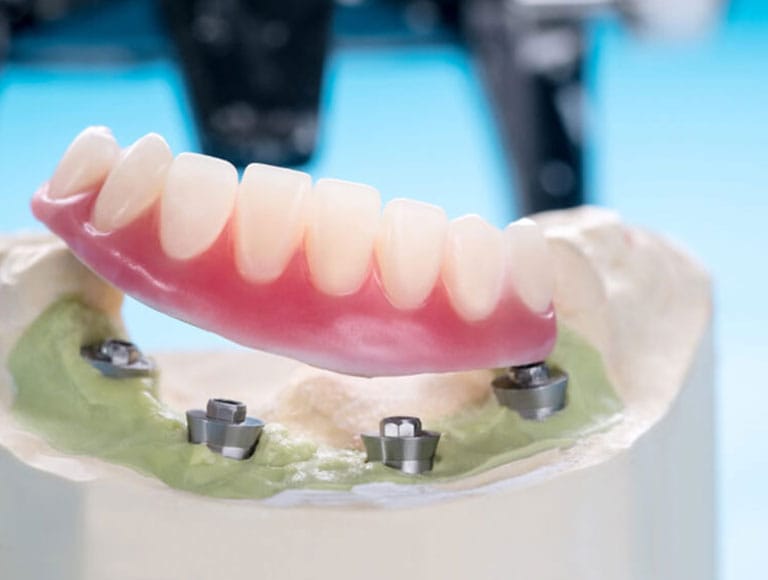 Implant-supported dentures — 123 iSmile Modesto CA