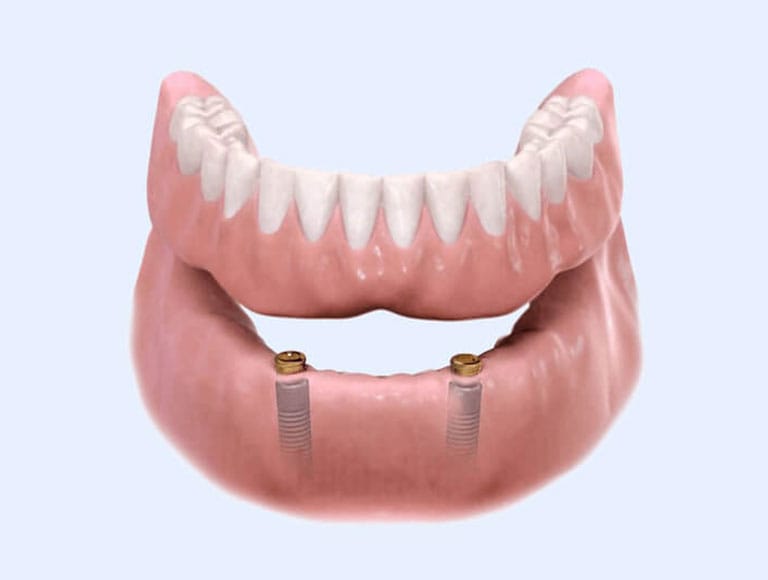 Fixed and removable dental implants — 123 iSmile Modesto CA