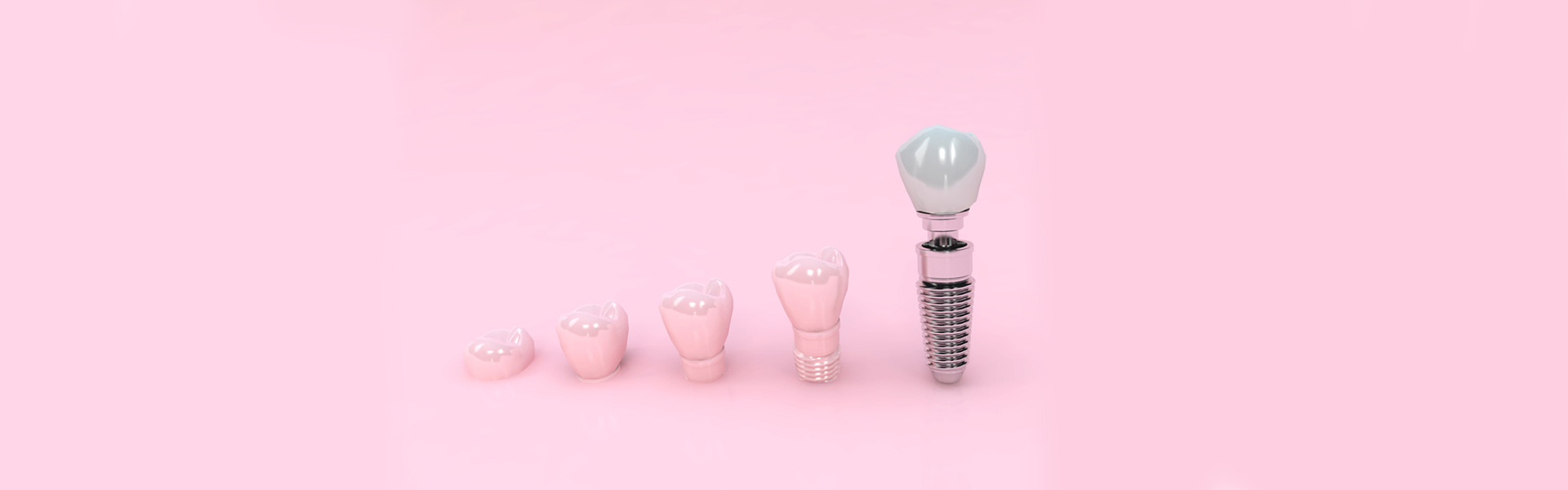 Dental Implants: Are They a Suitable Teeth Replacement Solution for You?