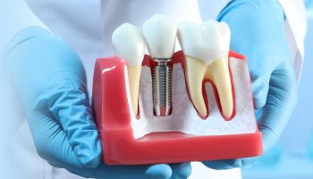 How To Choose the Right Dental Implant Professional?